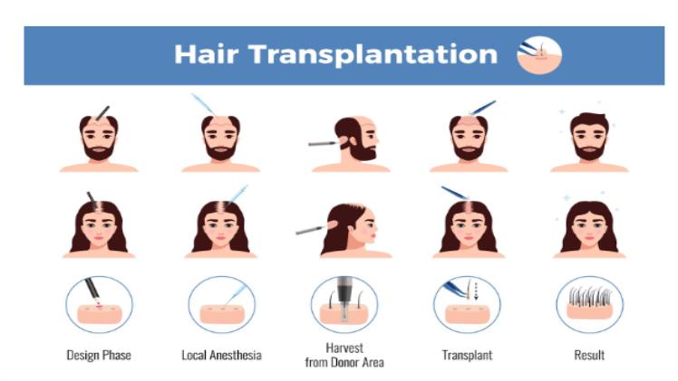 how-turkey-became-the-leading-destination-for-hair-transplants-scooptimes-1