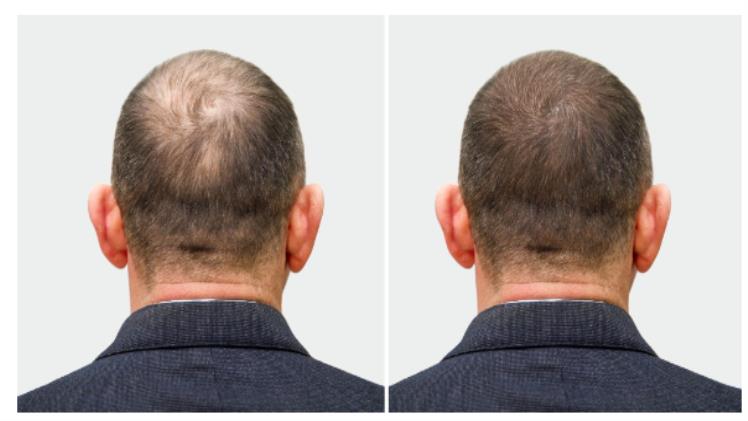 How Turkey Became the Leading Destination for Hair Transplants – Scooptimes